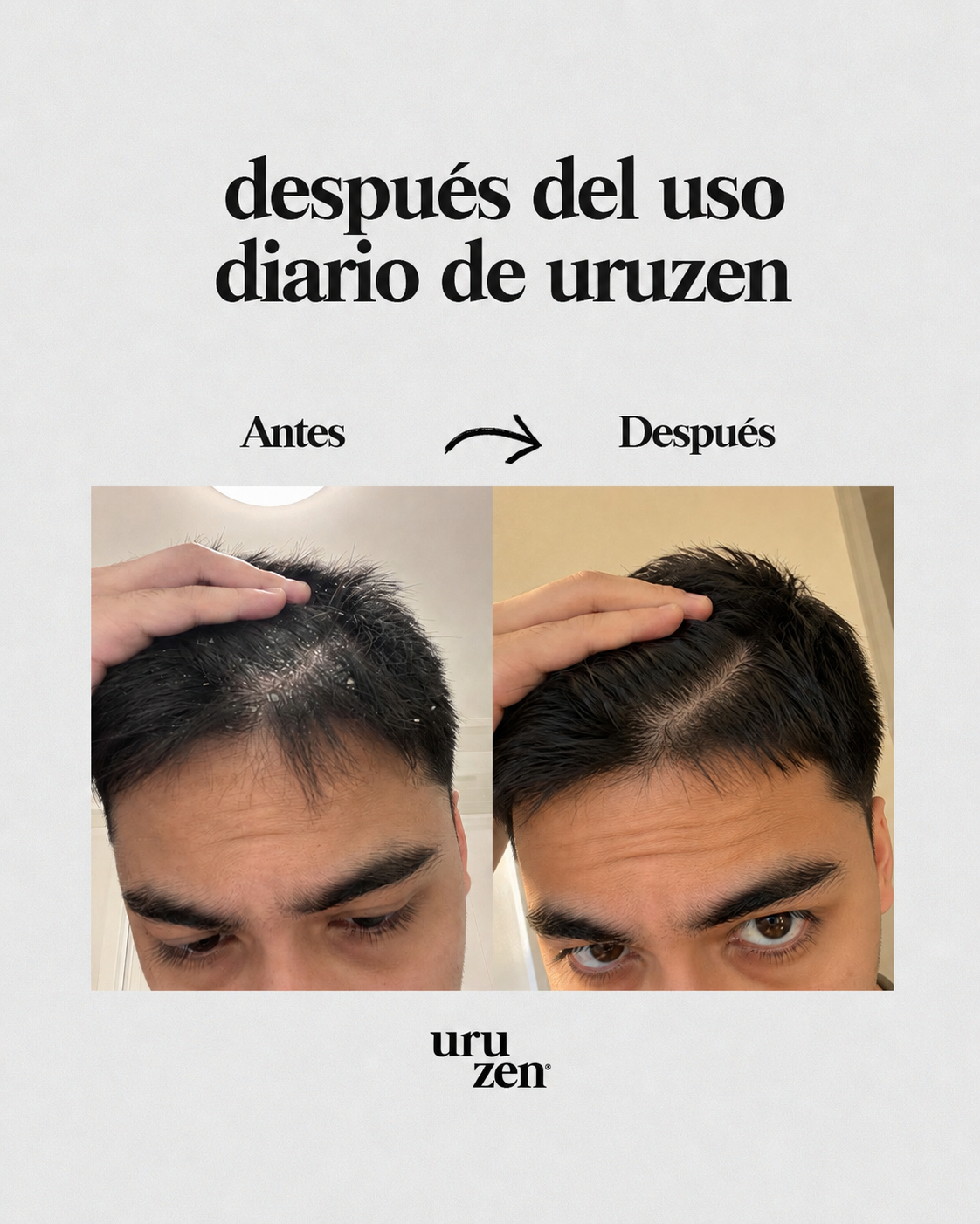 Elimina La Descamación y Picazón De Raíz