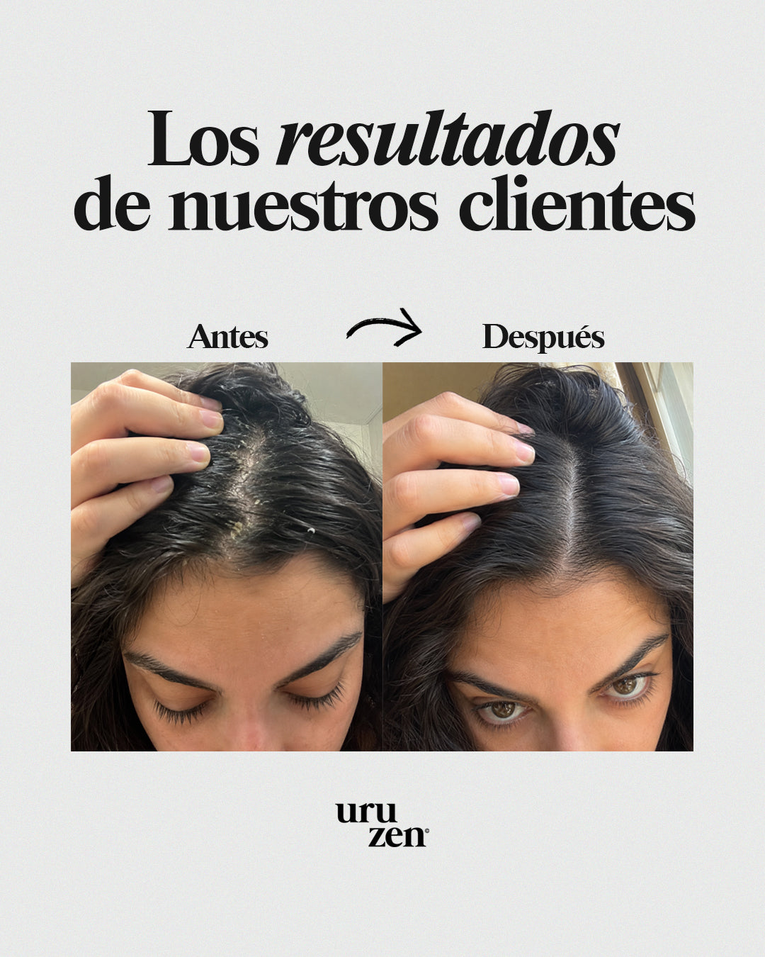 Elimina La Descamación y Picazón De Raíz